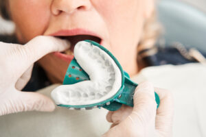 مواد ایمپرشن و پروتز دندانپزشکی: الاستومرها، ژل‌ها و قالب‌گیری دقیق