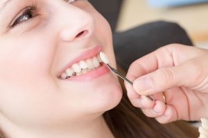 لمینت یا کامپوزیت؟ کدام‌یک برای زیبایی دندان شما مناسب‌تر است؟